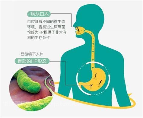 幽门螺杆菌阳性是什么意思