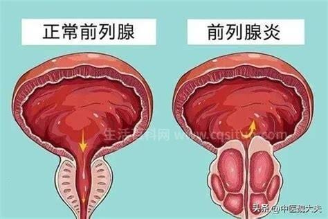 前列腺炎怎么引起的