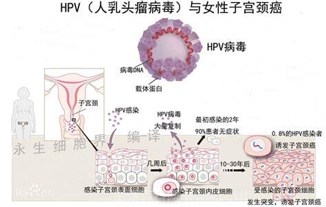 HPV感染怎么引起的