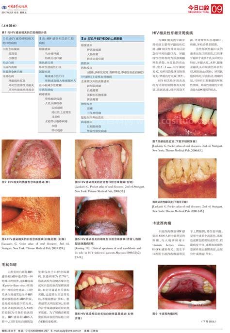 艾滋病牙龈症状