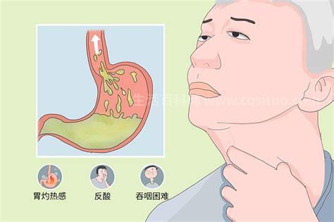 食道炎如何正确治疗