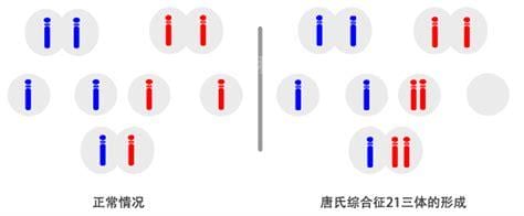 21三体综合症是什么原因造成的