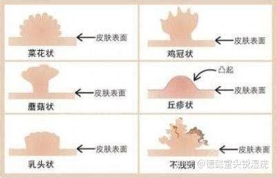 尖锐湿疣到底是怎么形成的