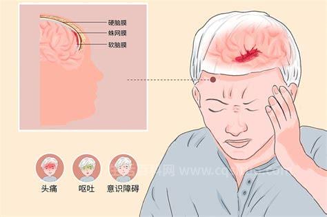 蛛网膜下腔出血常见原因