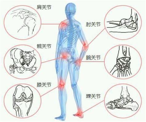 类风湿因子阳性是得了类风湿关节炎吗