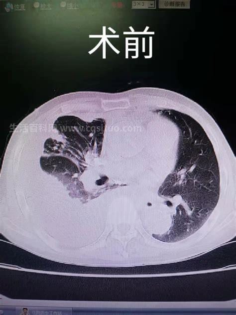 结核性胸膜炎需要休息多久