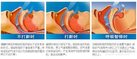 打呼噜的原因