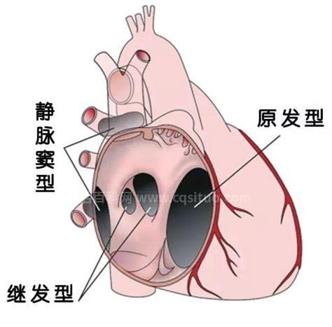 心脏房缺是什么意思