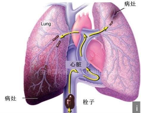 肺栓塞是什么病