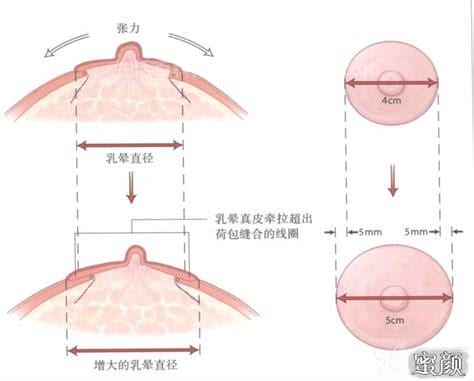 什么是乳晕缩小术