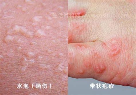 水泡和疱疹的区别图 水泡和疱疹的