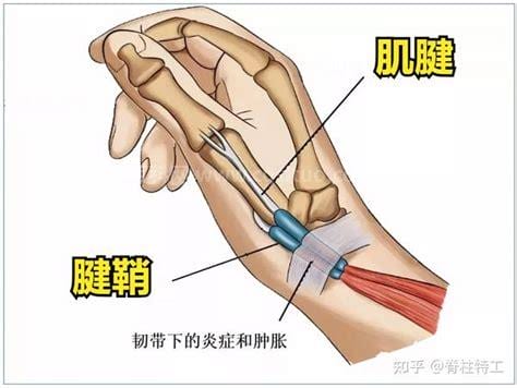 腱鞘炎挂哪个科