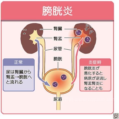 慢性膀胱炎有什么症状