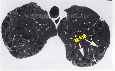 肺大泡是什么病严重吗