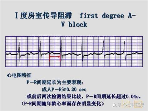 一度房室阻滞要紧吗