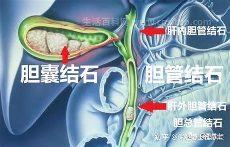 肝内胆管结石要紧吗