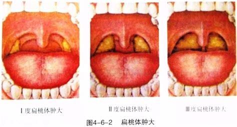 扁桃体炎可以吃橙子吗