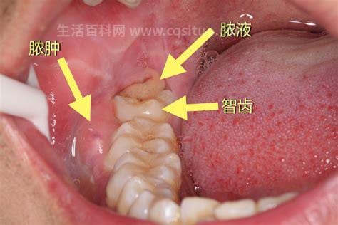 长智齿什么症状