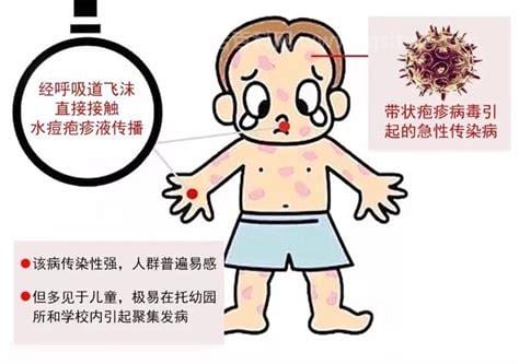 水痘通过什么传染