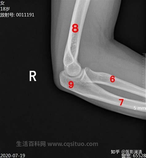 肘关节功能位正常多少度