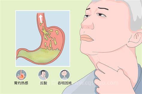 反流性食管炎的症状表现在哪里