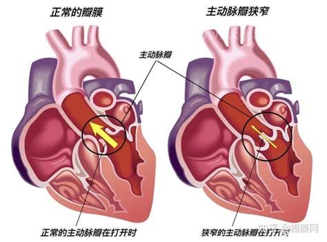 三尖瓣关闭不全轻度怎么处理