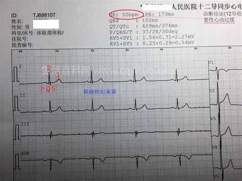 怎么看心电图报告单