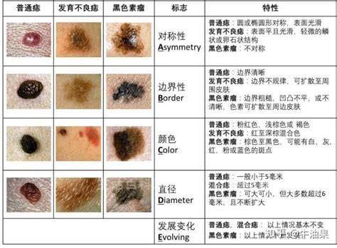 色素痣恶变的主要征象