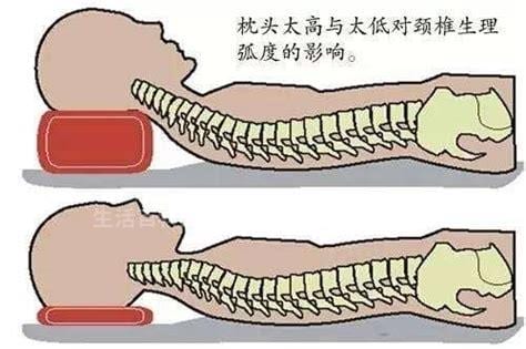 颈椎病的正确睡姿是什么