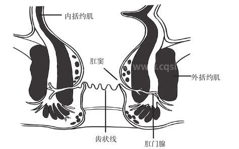 肛痿是怎么形成的