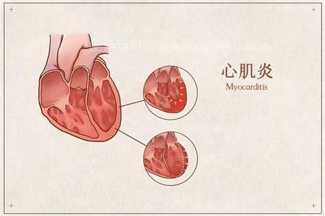 风湿性心包炎是绒毛心吗