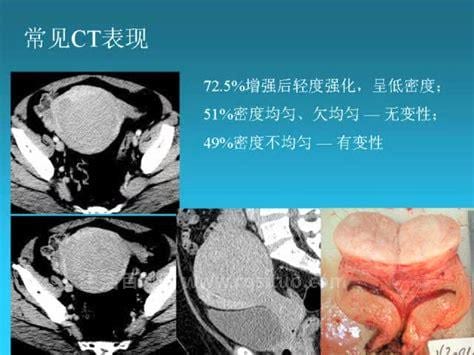 子宫平滑肌瘤的原因