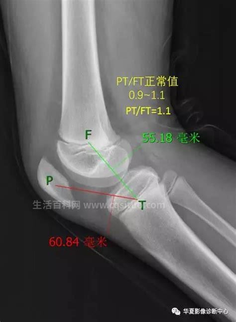 髌骨是指人体哪个部位