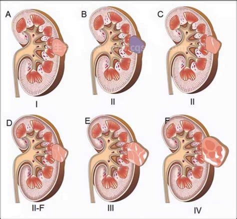 肾囊肿是怎么引起的