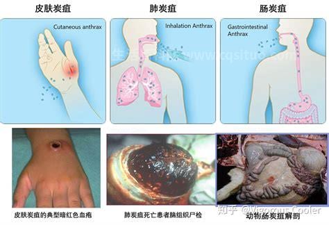 炭疽病皮肤表现有什么