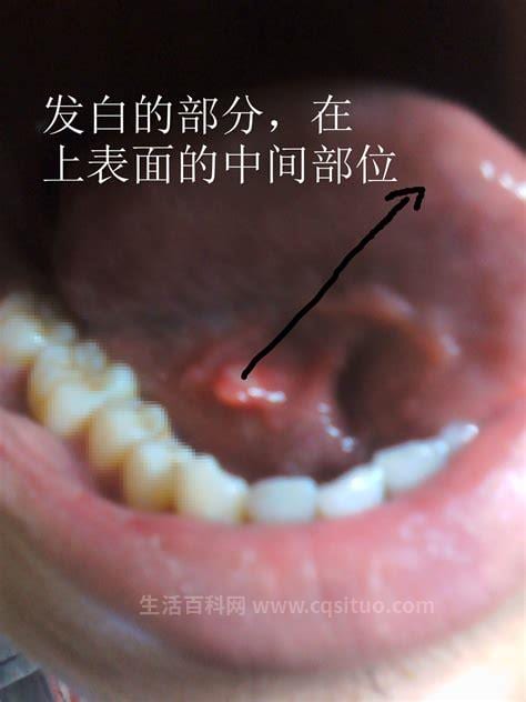 口腔粘膜白斑是癌症吗