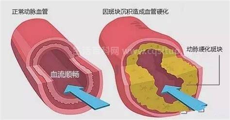 高血脂的症状特征是什么