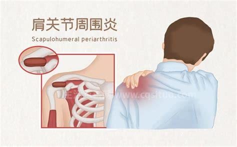 肩周炎的锻炼方法有哪些