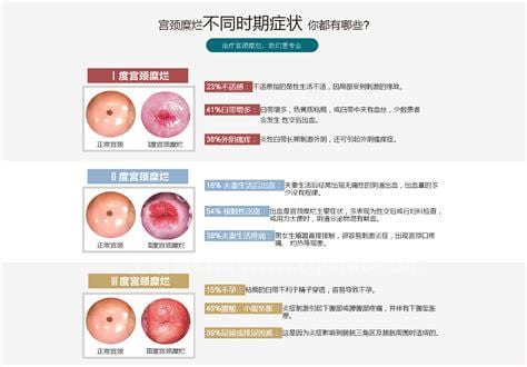 宫颈糜烂可以自愈吗