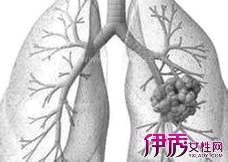 肺痨是什么意思