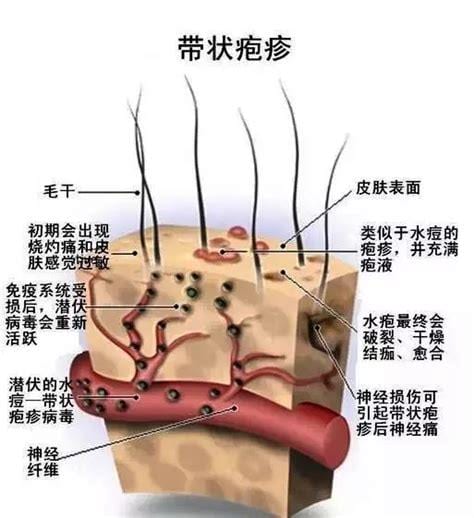 产生疱疹的原因