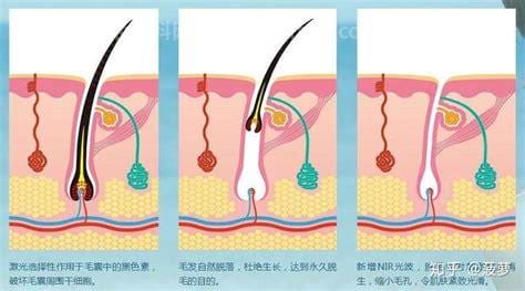 怎么样才可以永久脱毛