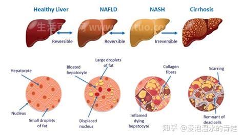 脂肪肝轻度是什么意思