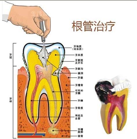 为什么牙髓炎只能根管治疗