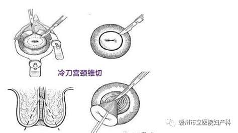 锥切后的宫颈能长全吗