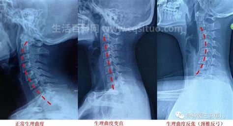 骨正基可以治颈椎病吗