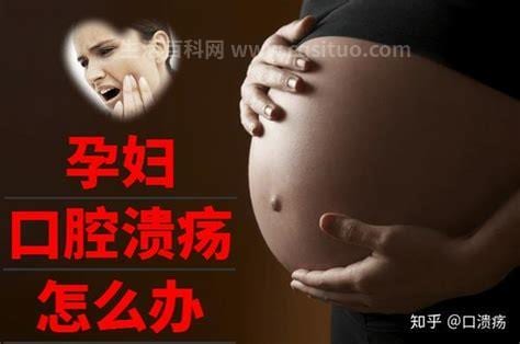 孕妇怎么处理口腔溃疡