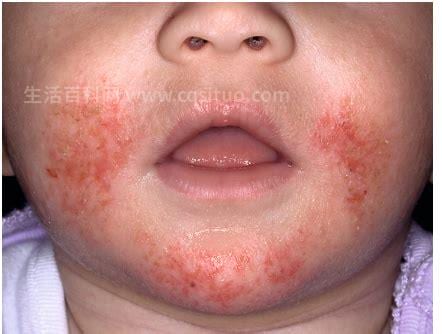 湿疹性皮炎什么是湿疹性皮炎湿疹性皮炎