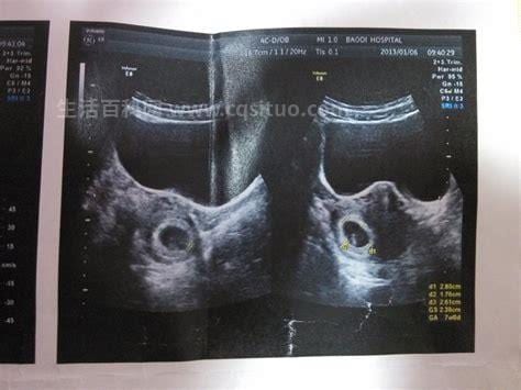 怀孕多少天b超可以看到孕囊