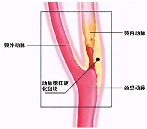 颈动脉狭窄是什么情况